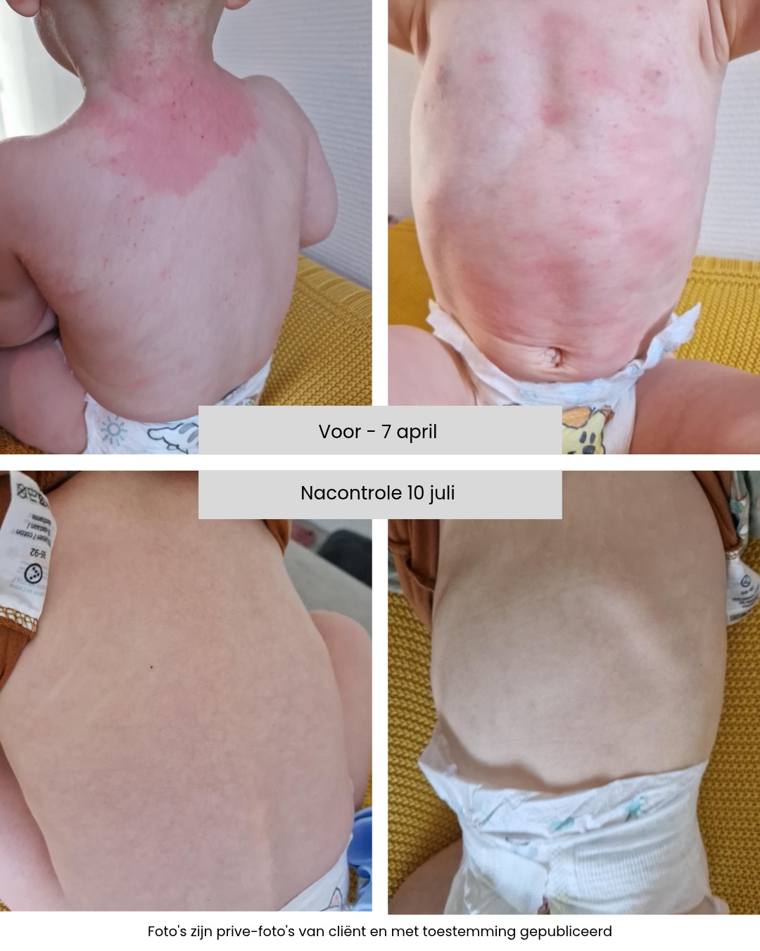 Before After eczeem
