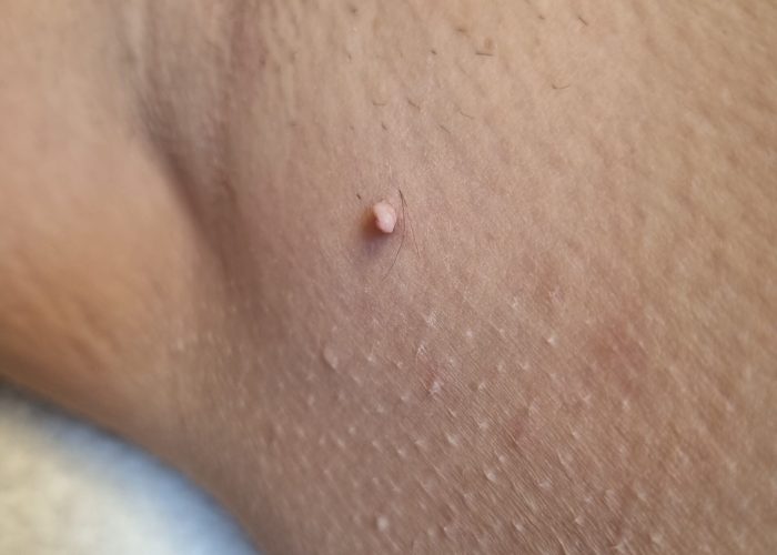 fibroom